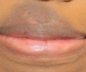 Dark Skin on Upper Lip