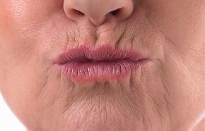 Upper Lip Wrinkles and Lip Lines around Mouth