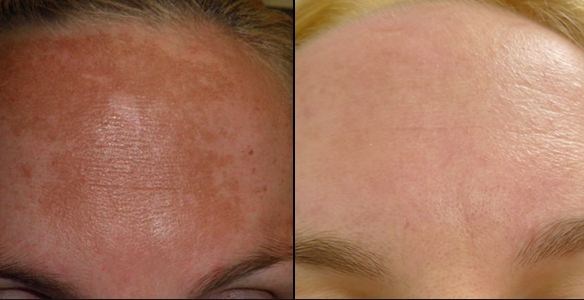 Before and after chemical peels for melasma
