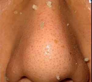 Big clogged face pores are prominent on the nose