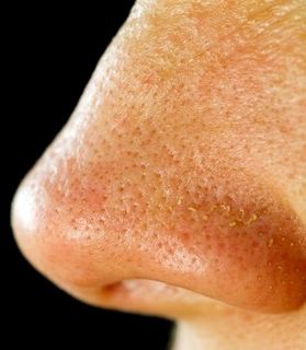 How to reduce pores on nose and face