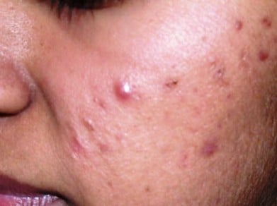 How to get rid of dark spots from acne naturally