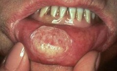 Lip Cancer