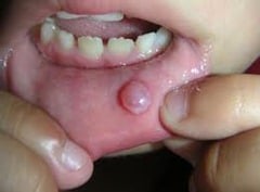Mucous Cyst Appering as White Spots on the Lips