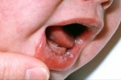 Oral Thrush White Spots on Lips