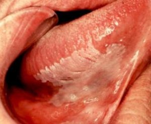 White Patch under Tongue