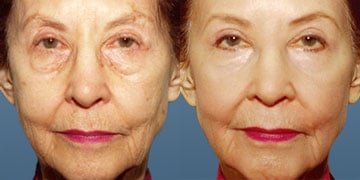 Retin A for Wrinkles – Best Cream, Dosage, How to Use Retin A for