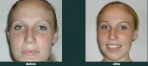Chrmotherapy eyebrow hair loss