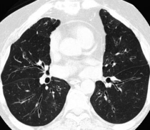 Dangers of Microwave Popcorn - Porous Lungs
