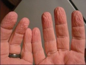 Pruney fingertips