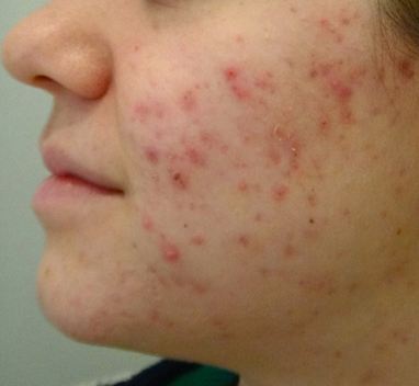 Acne scars can end up as hyperpigmented areas