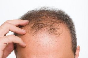 Hair-Growth-for-Men-after-Hair-Loss