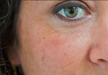 How to fade dark age spots