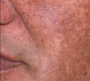 Hyperpigmentation can occur on black skin, fair skin, olive skin etc