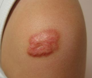 Keloid scar removal