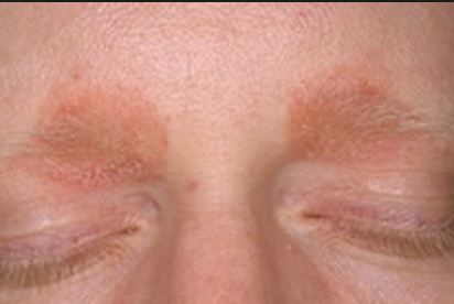 Cradle cap in adults around eyebrows, ears and forehead