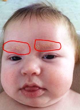 Eyebrows with cradle cap