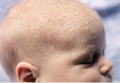 Does olive oil get rid of cradle cap