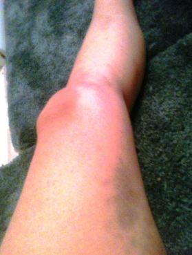 Bruising easily on legs on waking up