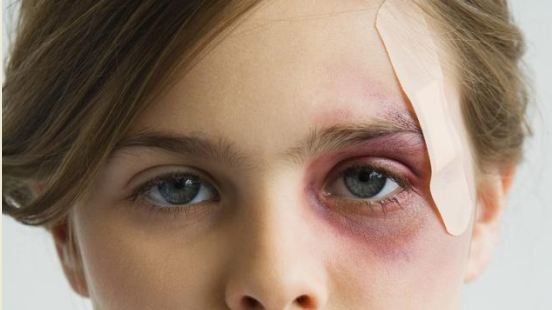 Does your child bruise with ease Could he be having anemia