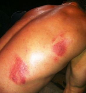 Falling down may cause multiple injuries to internal organs
