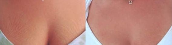 Microdermabrasion before and after (Courtesy of medicalcrystals)