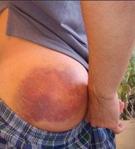 Parts of the body such as stomach and buttocks can bruise randomly.