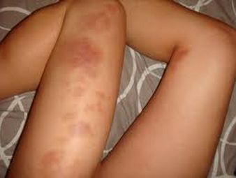 What causes easy bruising on thighs and legs