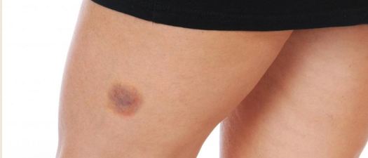 What does quick bruising mean and what causes it