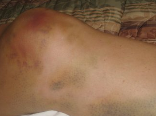 badly bruised knee bone