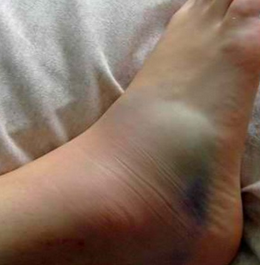 how to heal a bruised ankle from running