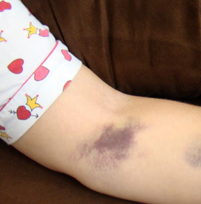 bruised arm muscle