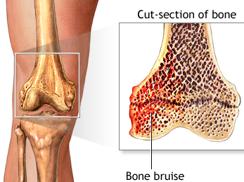 How to heal and treatment for deep knee bone bruising