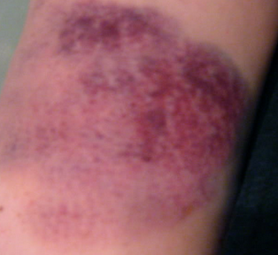 bruised arm muscle