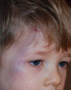 internal bruising signs