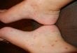 How to get rid of chigger bites fast